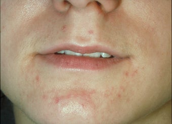 Lip augmentation before 115102