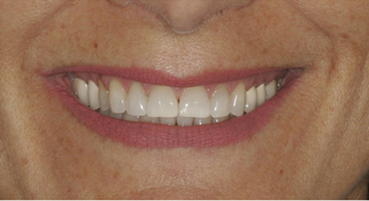 Smile makeover before 478964