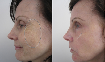 SmartXide Fractional CO2 Resurfacing 387845