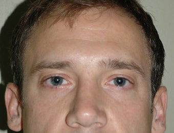 Rhinoplasty after 118340