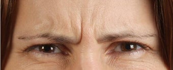 Botox Results before 271679