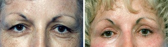 Blepharoplasty before 643243