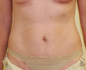 Mini-abdominoplasty after 493674