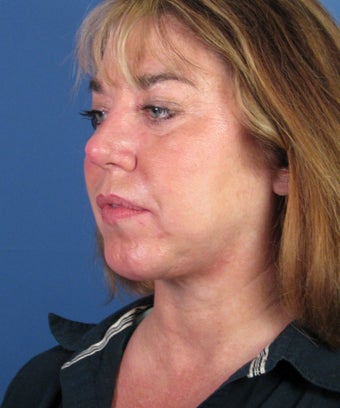 Chin Implant 550579