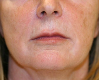 Lip Lift before 380418