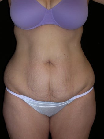Tummy tuck before 275256