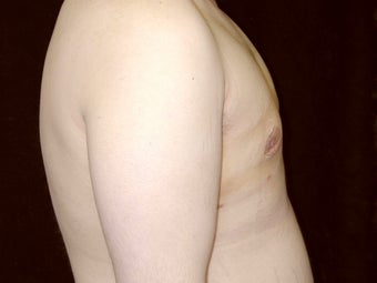 Gynecomastia Reduction Surgery after 238729