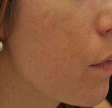 Acne Scarring 426033