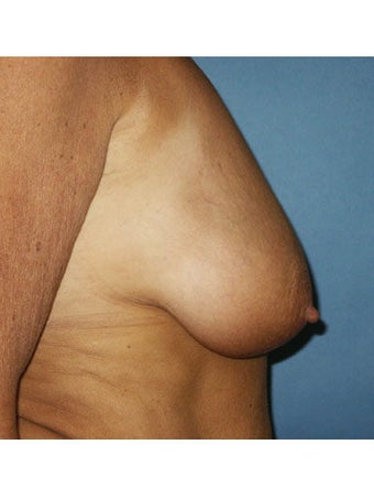 Bilateral mastopexy augmentation with placement of smooth saline breast implants. Right implant 300cc filled with 360cc, left i before 249996