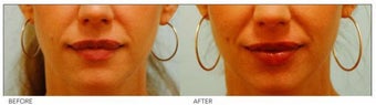 Lip Reduction/Lip Correction before 136731