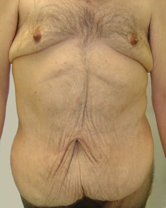 Bodylift & removal of excess chest skin before 527247