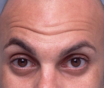 Cosmetic Microdroplet BOTOX® Treatment before 118541