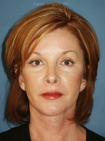 Facelift, Endoscopic Browlift, Upper and Lower Blepharoplasty, Perioral Dermabrasion after 248923