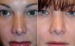 Non surgical nose job before 586202