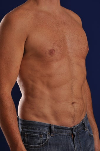 Vaser Hi Def Liposuction of the abdomen, chest, back, and flanks with fat injections to the pectoralis region after 248829