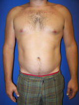 Pec Implants before 130081