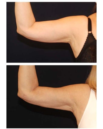 Liposuction before 286791