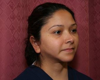 liposuction of neck & jaw line for women in Los Angeles after 583586