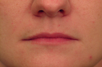 Injectable Filler before 149356