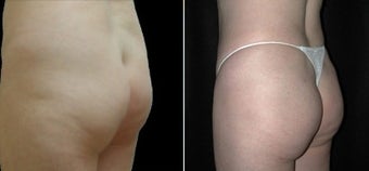 Buttock Augmentation before 110103