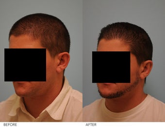 Otoplasty before 253185