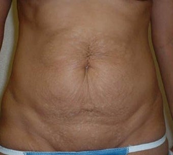 Tummy Tuck before 137947