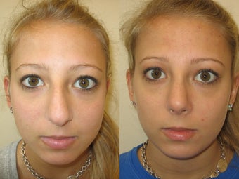 Rhinoplasty after 223020