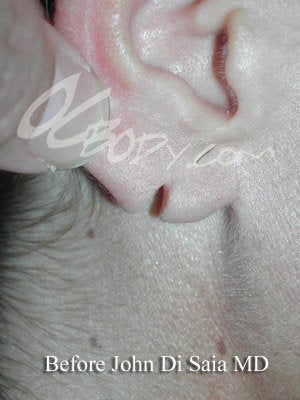 Ear Repair - Earlobe before 84599