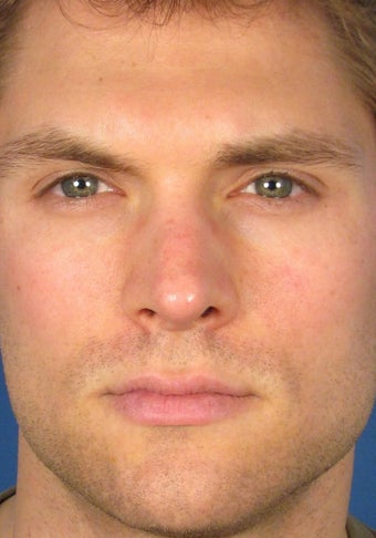 Revision Rhinoplasty after 410605