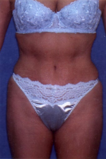 Tummy Tuck with Liposuction after 411589