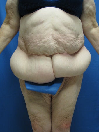 Circumferential Body Lift before 364633