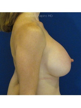 Bilateral Perioareolar Mastopexy with placement of subpectoral 659cc smooth silicone gel implants after 249982