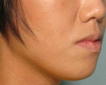 Radiesse in the chin before 343304