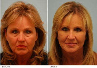 Restylane before 375285