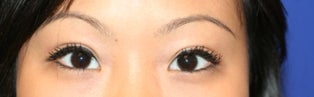 Asian Double Eyelid Surgery after 507305