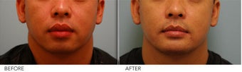 Lip Reduction for Correction of Silicone after 361407