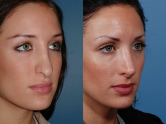 Revision rhinoplasty 435947