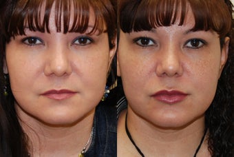 Lip Augmentation with Silikon-1000 before 351129