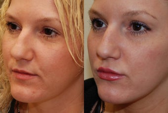 Lip Augmentation with Silikon-1000. 2 treatments. before 487941