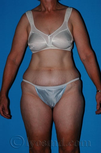 Lower Body Lift with Tumescent Liposuction before 233082