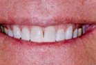 Kor Deep Bleaching Tooth Whitening System after 257924
