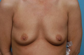 Breast Augmentation before 547809