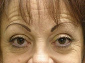 Brow Lift before 541478