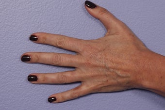 Radiesse to Hands before 308304
