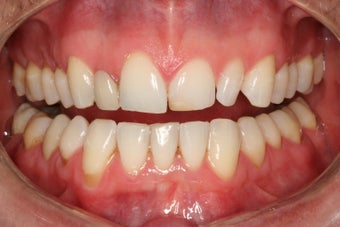 Tooth replacement in the smile 382033