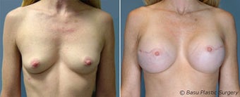 Breast reconstruction before 270824