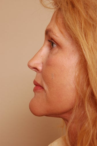 Refresher Facelift w/Neck Pliction, Browlift, TCA Peel Lower Lids, Fat Injections to Cheeks & Lips after 252878