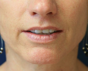 Lip lift after 605281