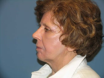 Quicklift w/neck liposuction after 580276