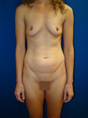 Mommy makeover - Tummy tuck and breast augmentation before 162001